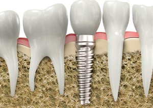 Implantes Dentales en Coruña